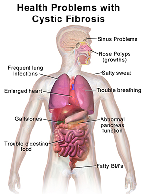 Cystic Fibrosis